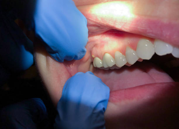 Emergency Dental Filling Replacement in VA